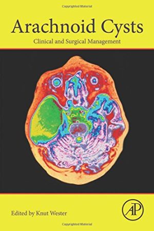 Arachnoid Cysts: Clinical and Surgical Management (PDF)