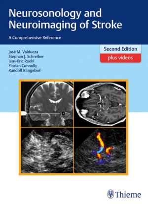 Neurosonology and Neuroimaging of Stroke: A Comprehensive Reference 2nd (PDF)
