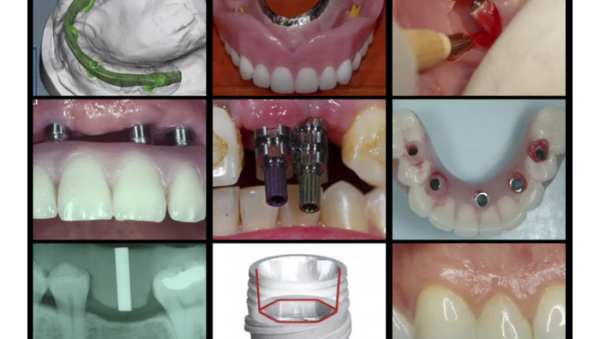 gidedental a z in restorative implant dentistry cme videos 63a22904d8526 | Medical Books & CME Courses