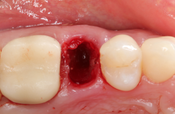 gidedental extraction socket preservation grafting immediate vs delayed implants pontic site development 2020 cme videos 63a228a5a3424 | Medical Books & CME Courses