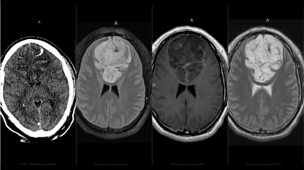 mrionline imaging mastery series adult glioma imaging 2021 cme videos 63a12be189a7d | Medical Books & CME Courses