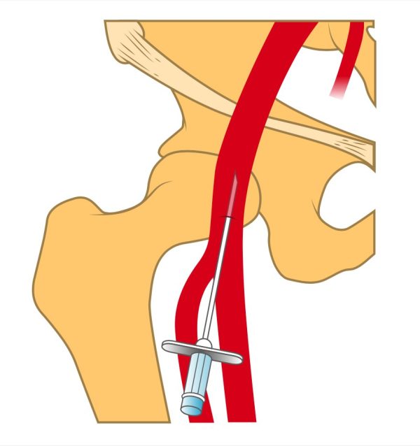 mrionline imaging mastery series arterial access principles pearls pitfalls and complications 2021 cme videos 63a14dd3255ce | Medical Books & CME Courses