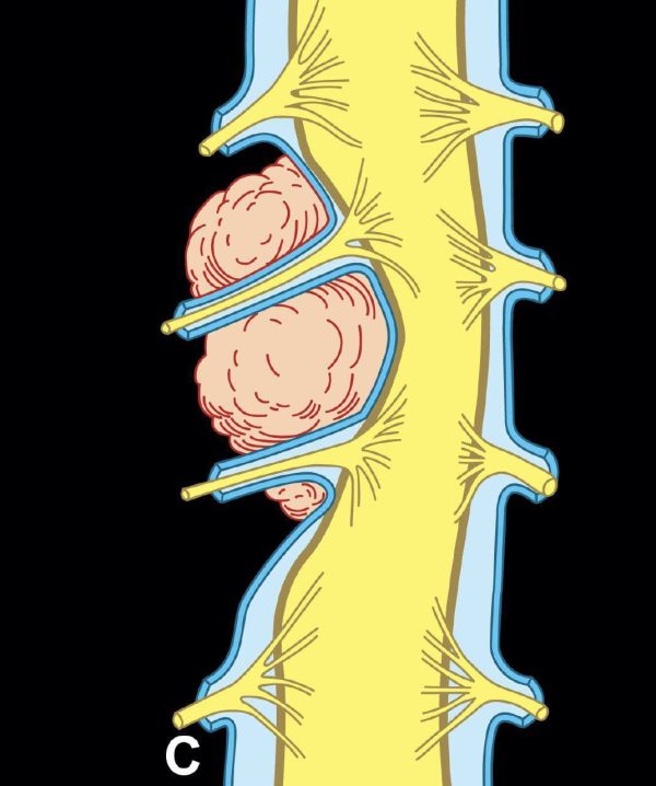 mrionline mri mastery series extradural lesions 2020 cme videos 63a1610203ae7 | Medical Books & CME Courses