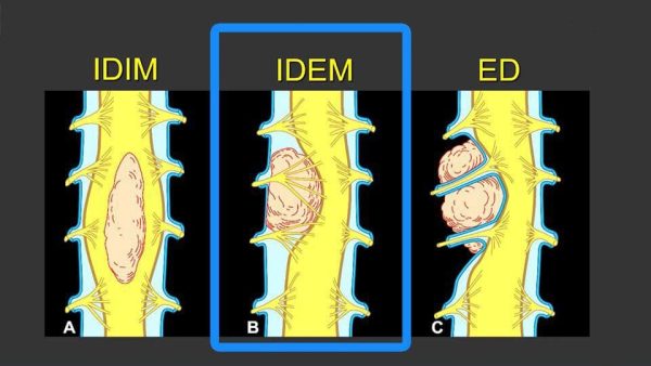 mrionline mri mastery series intradural extramedullary lesions idem 2020 cme videos 63a160eb357f1 | Medical Books & CME Courses