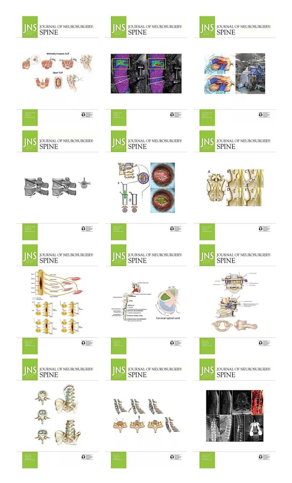 journal of neurosurgery spine 2022 full archives true pdf 63edf80582578 | Medical Books & CME Courses