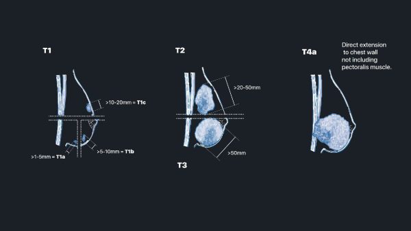 mrionline mastery series evaluation of newly diagnosed pre operative breast cancer patients 2021 cme videos 63ec45094f169 | Medical Books & CME Courses