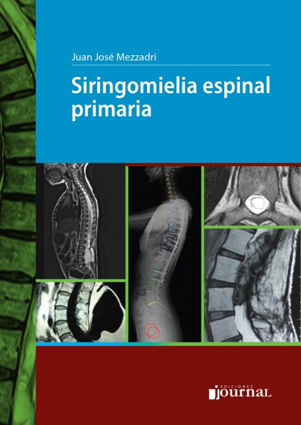 siringomielia espinal primaria high quality image pdf 64d6ce96a8f2b | Medical Books & CME Courses